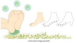 Onychomycosis  What is it and how is it treated [upl. by Aisak]