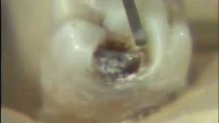 Removal of Carious Lesion [upl. by Ignatia]